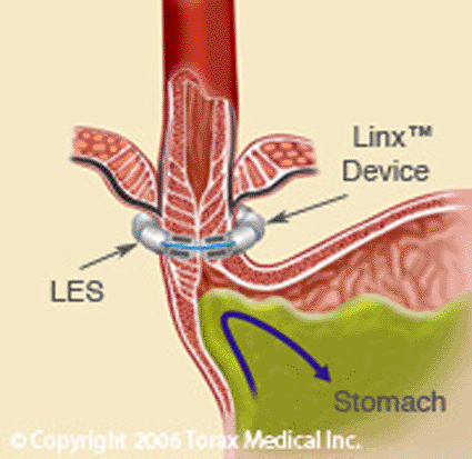 Imagen: El dispositivo LINX está diseñado para aumentar el esfínter esofágico inferior para prevenir el reflujo mientras acomoda la función normal de deglución (Foto cortesía de Torax Medical Inc.)
